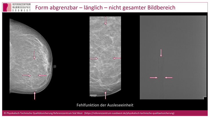 Störstrukturen in der digitalen Mammographie